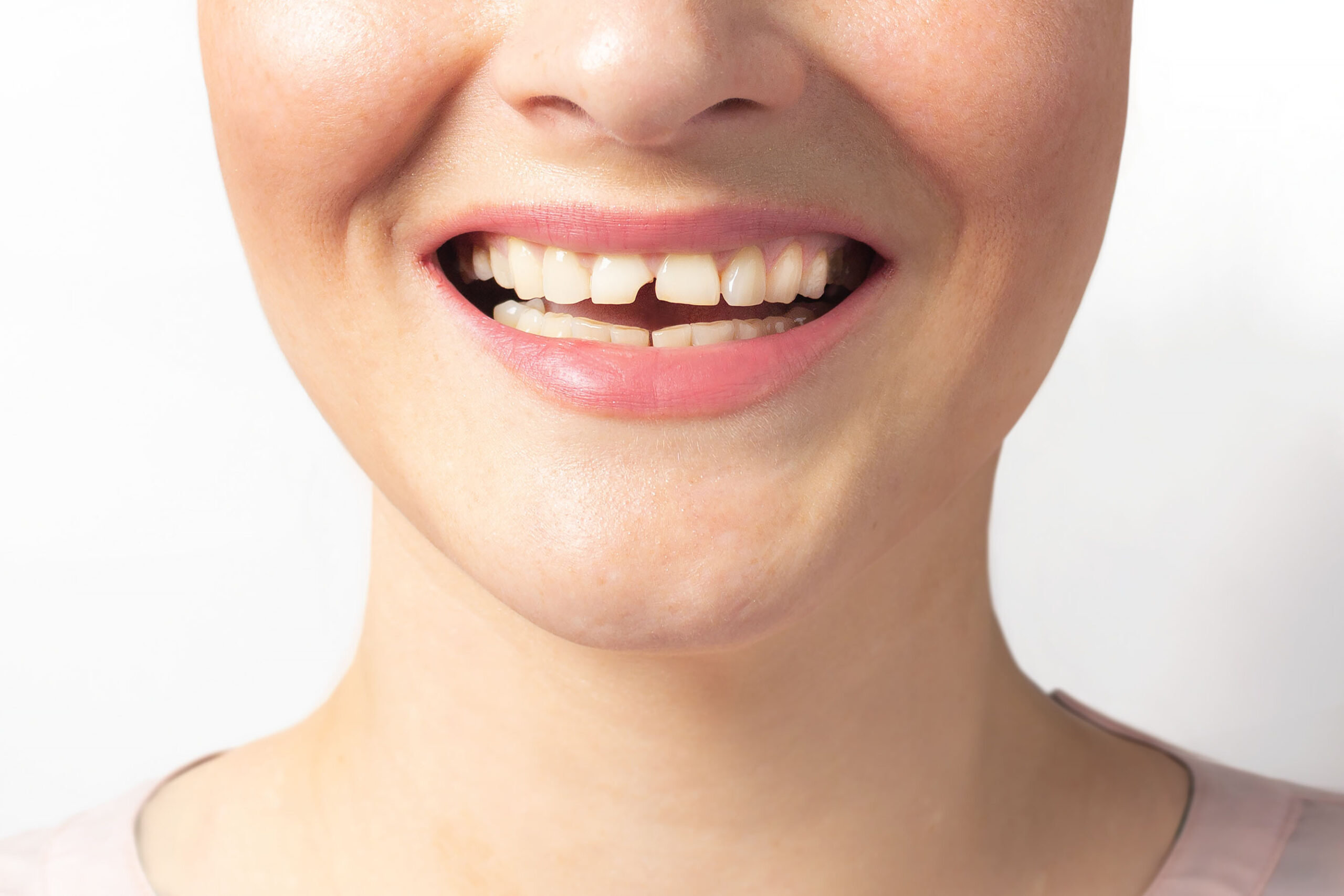 What Can A Dentist Do About A Chipped Tooth?